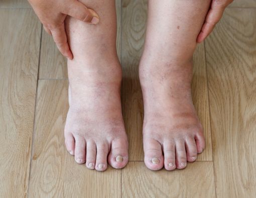 Gejala Penyakit Jantung yang Terlihat di Kulit