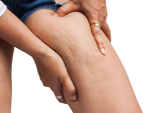 3 Cara Mengurangi Selulit