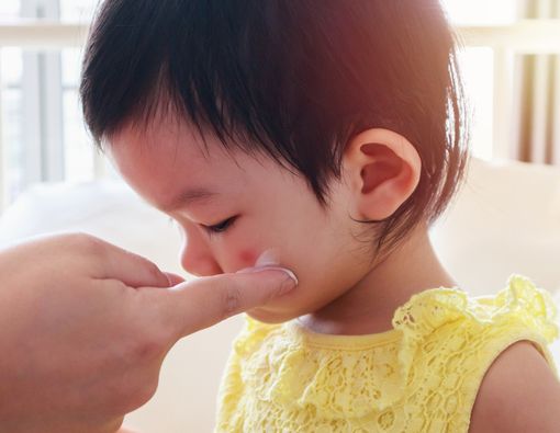 Ini Cara Menghilangkan Bekas Cacar Air yang Mengganggu