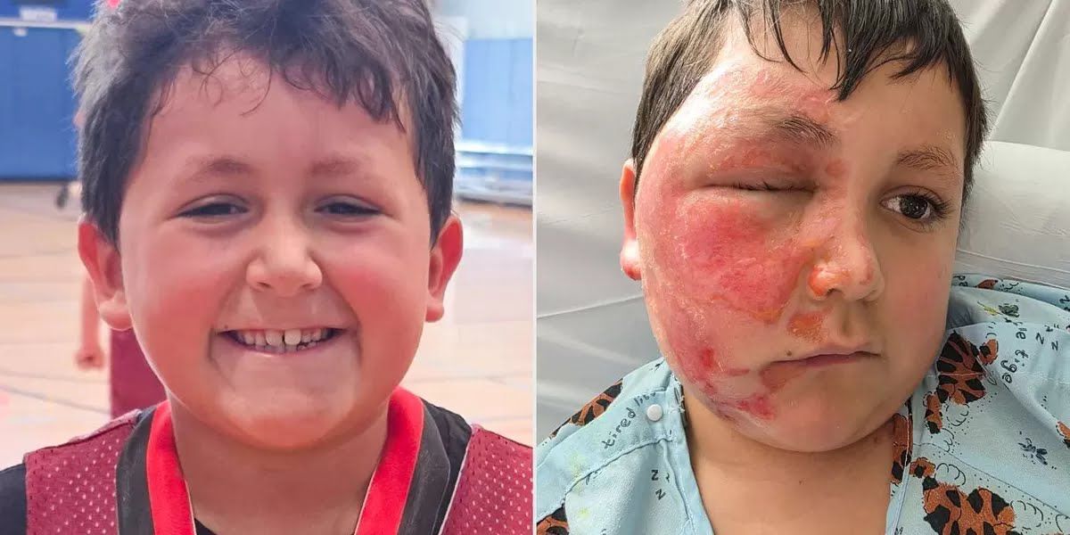 Akibat Ugal-Ugalan dalam Mengikuti Trends Media Sosial Anak 9 Tahun Mengalami Luka Bakar