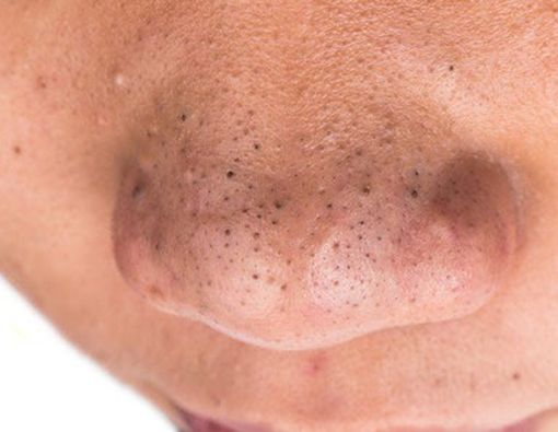 Cegah Komedo Timbul Kembali dengan Cara Ini!