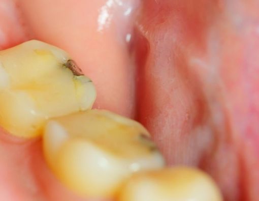 Perawatan Gigi Bercelah dengan Metode Tambal Gigi