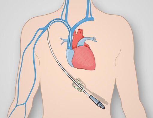 Apa yang Terjadi Selama Kateterisasi Jantung?