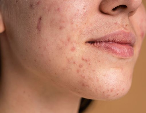 8 Obat Jerawat Alami yang Bisa Dicoba di Rumah