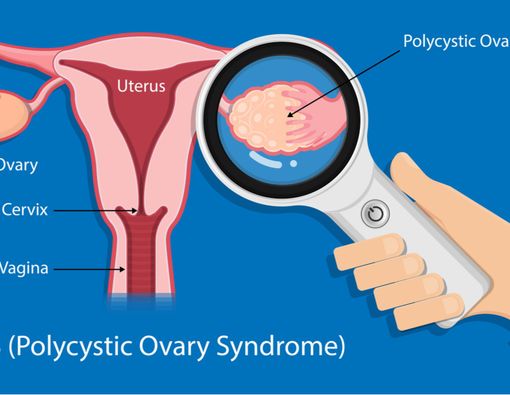Kenali PCOS Lebih Jauh