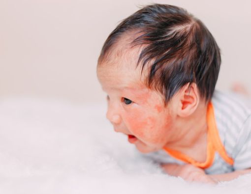 Mama Harus Tahu, Ini 5 Cara Mencegah Eksim dan alergi pada Bayi