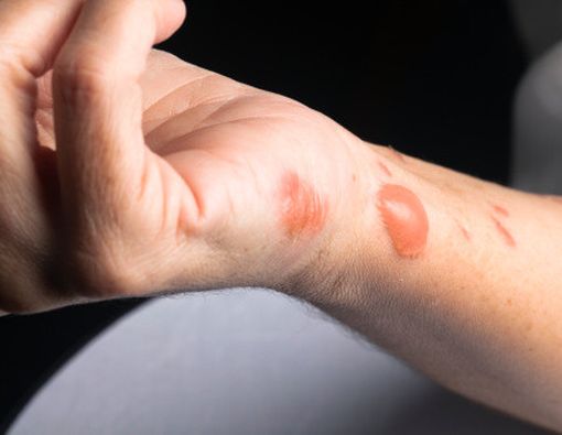 Luka Bakar? Jangan Disiram Kecap!