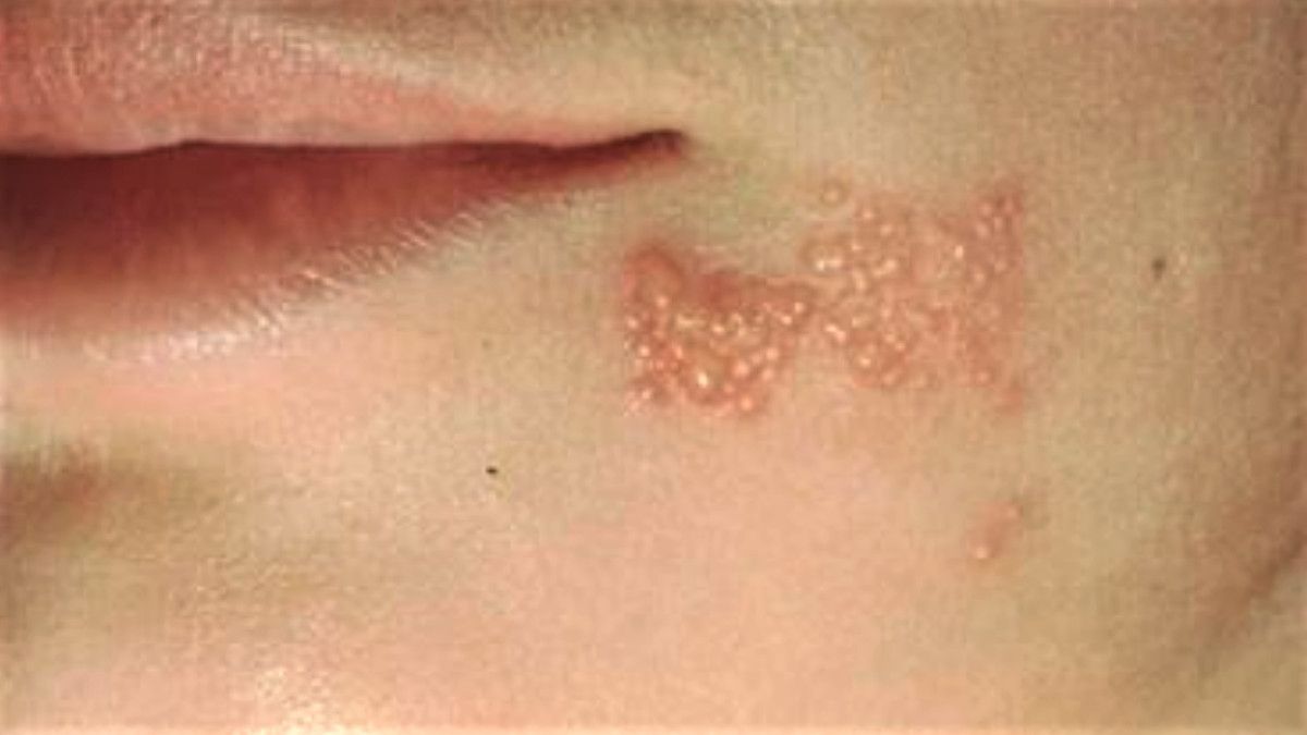 Herpes di Wajah, Waspada Herpes Zoster Oftalmikus