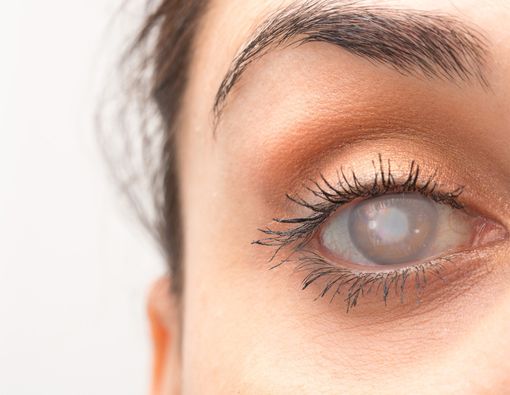 Ultraviolet Memacu Risiko Katarak