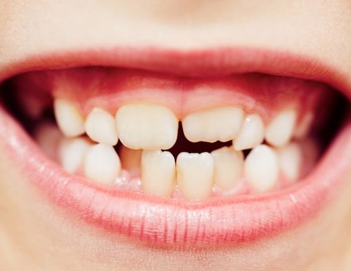 Berbagai Kelainan Bentuk Gigi yang Perlu Anda Tahu