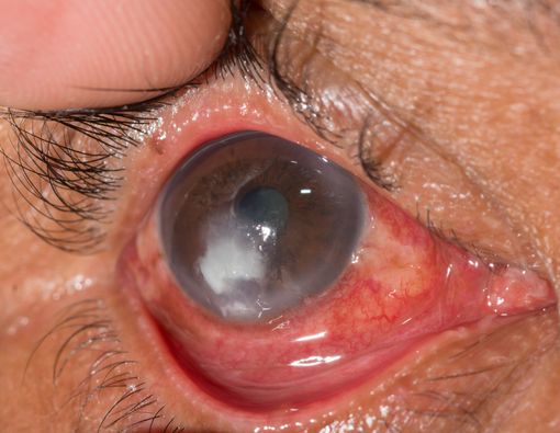 Ada Titik Putih di Mata, Waspada Ulkus Kornea!