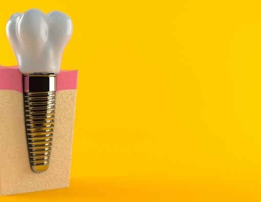 Benarkah Implan Gigi Membuat Tulang Rahang Keropos?