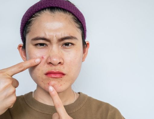 12 Cara Ampuh Menghilangkan Jerawat di Pipi