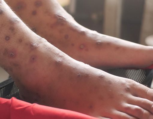 Penyakit Cacar Monyet, Gangguan Kesehatan Apa Ini?