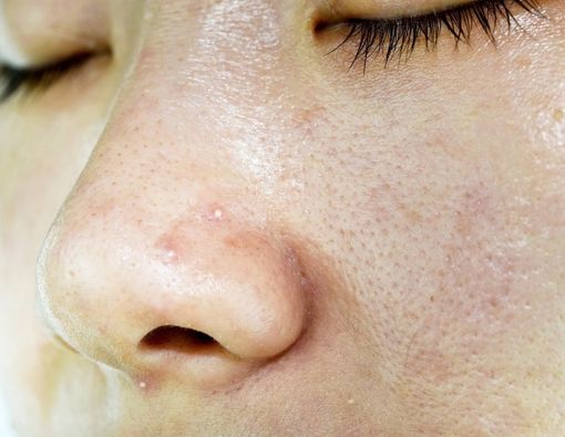 Faktor Risiko Munculnya Solar Comedones di Wajah