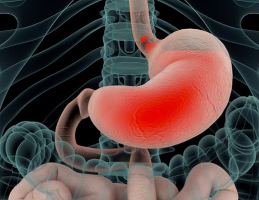Mengenal Pemicu, Gejala dan Cara Mencegah Gerd