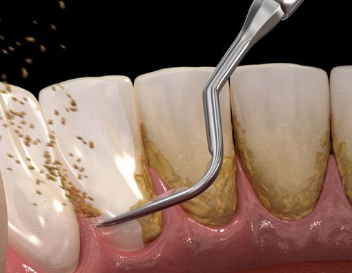 Habis Scaling Gigi Jadi Renggang, Apa Penyebabnya?