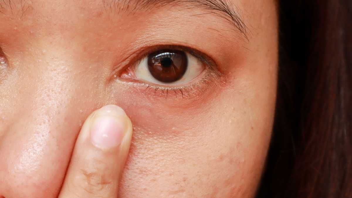 Penyebab Bintik Putih di Kelopak Mata Bagian Dalam