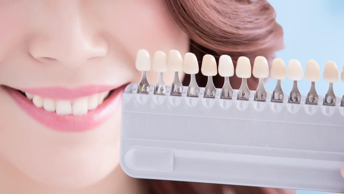 Penyebab dan Cara Mengatasi Veneer Gigi yang Menguning