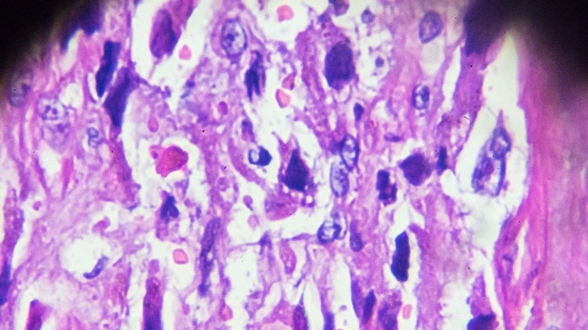 Koriokarsinoma, Tumor yang Bisa Mengancam Kesehatan Ibu Hamil