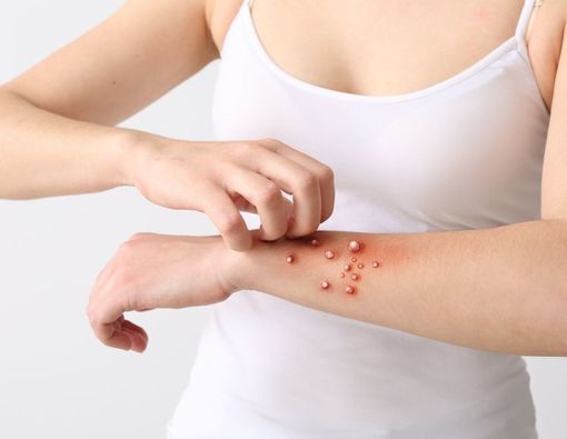 6 Cara Penularan Cacar Monyet (Monkeypox) yang Harus Diwaspadai