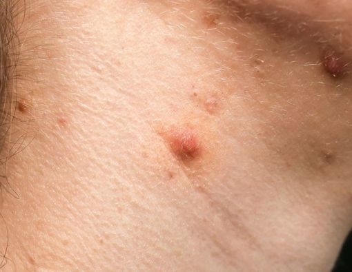 Penyebab Jerawat di Leher yang Bisa Ganggu Penampilan