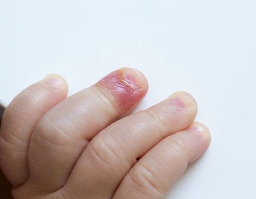 Cara Ampuh Cegah Kuku Cantengan