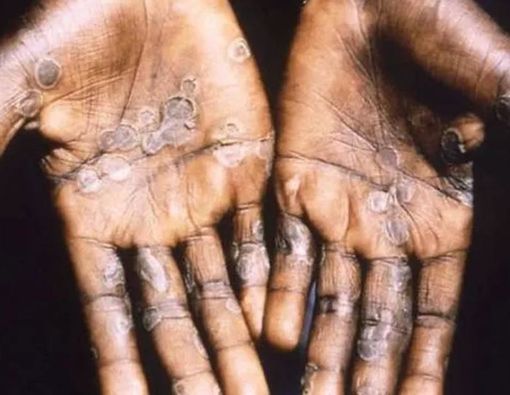 Kenali 7 Gejala Cacar Monyet untuk Lakukan Pencegahan