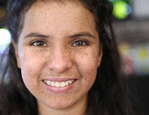 Tak Boleh Kena Matahari, Kenali Gejala Xeroderma Pigmentosum