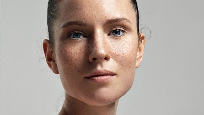 Apa Bedanya Freckles dan Flek Hitam?
