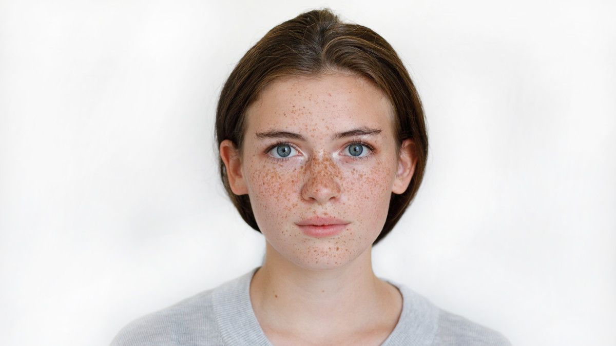 Trik Merawat Kulit Wajah yang Dipenuhi Freckles