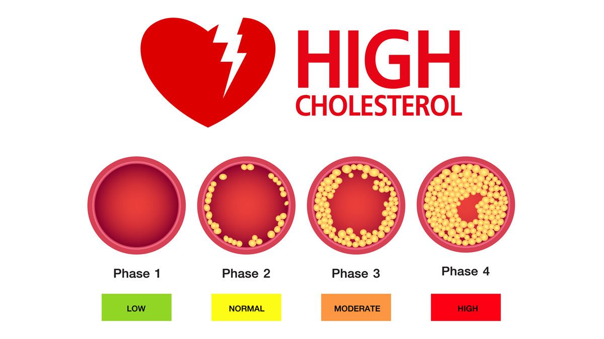 5 Kondisi Akibat Kadar Kolesterol Tinggi