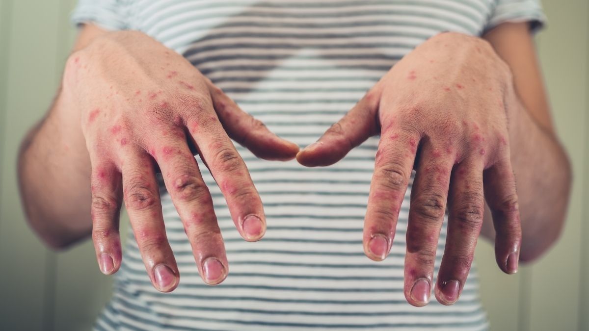 Komplikasi Flu Singapura yang Mesti Anda Waspadai