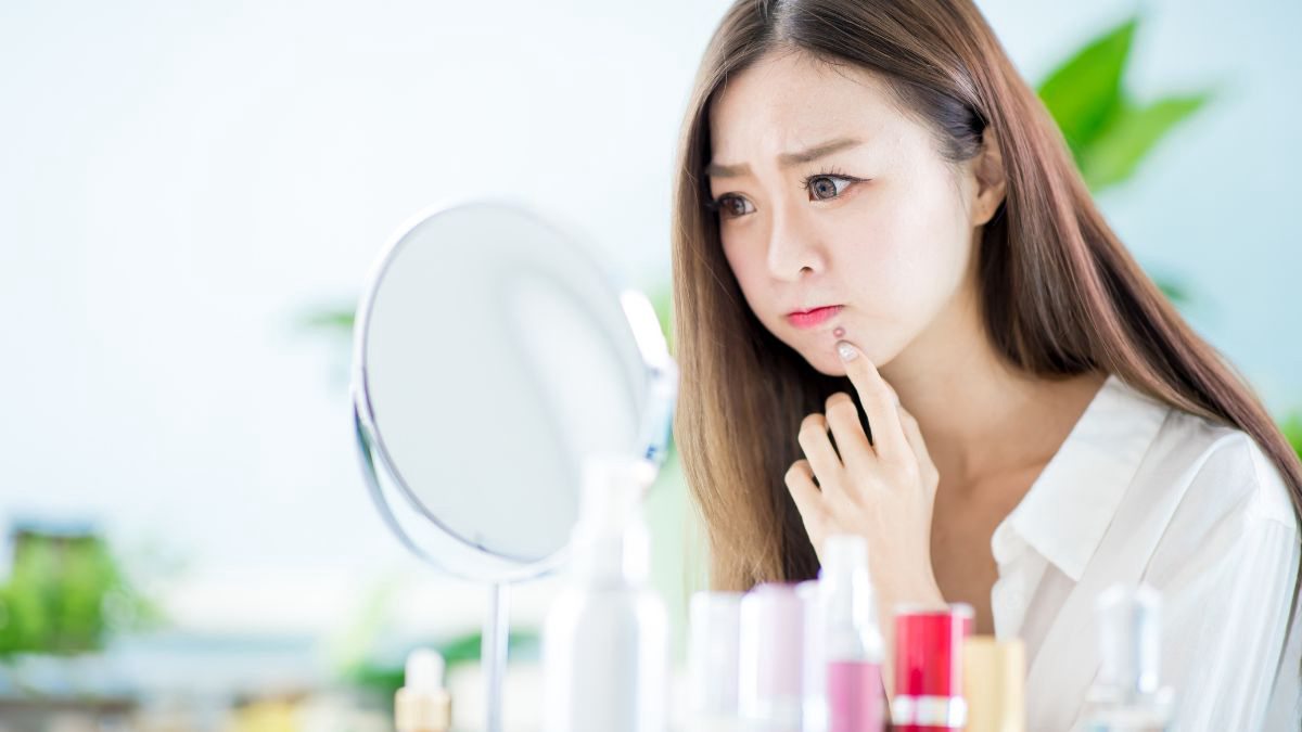 Cara Efektif Menghilangkan Jerawat di Dagu