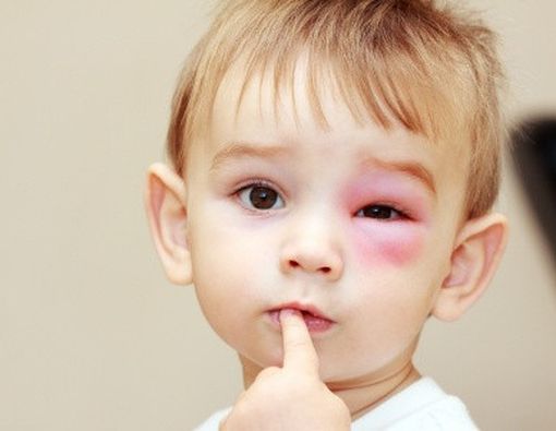 Pertolongan Pertama Jika Si Kecil Tersengat Lebah