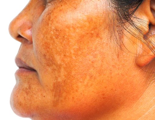 Ini Dia 4 Penyebab Melasma