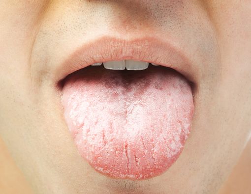9 Penyakit Serius Penyebab Lidah Berwarna Putih