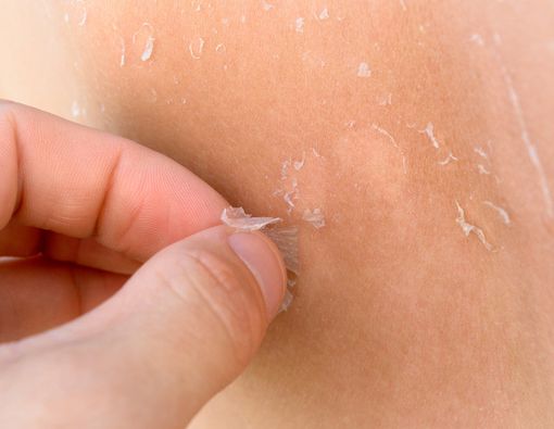 6 Cara Atasi Kulit Wajah yang Mengelupas Agar Halus Kembali