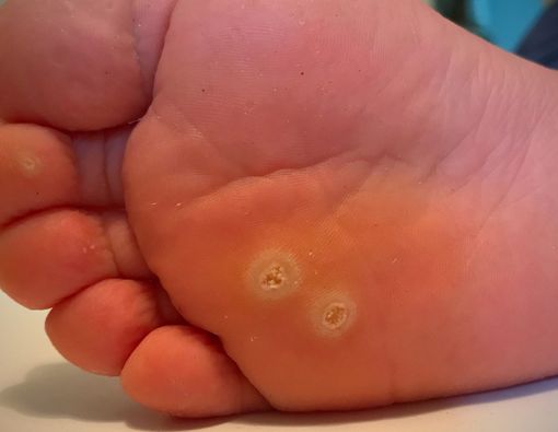 Cara Menghilangkan Mata Ikan yang Menjengkelkan