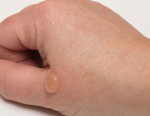 9 Penyebab Kulit Melepuh dan Cara Mengatasinya