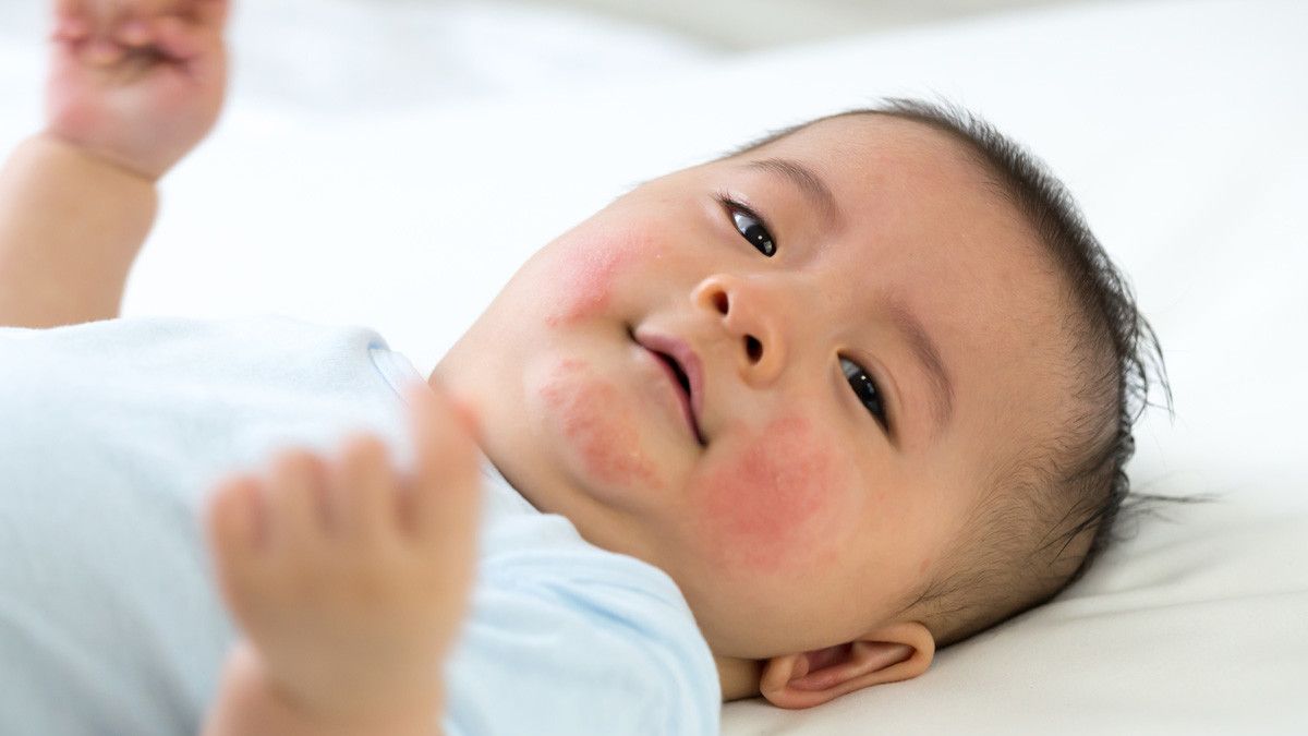 Alergi pada Kulit Bayi yang Perlu Anda Tahu