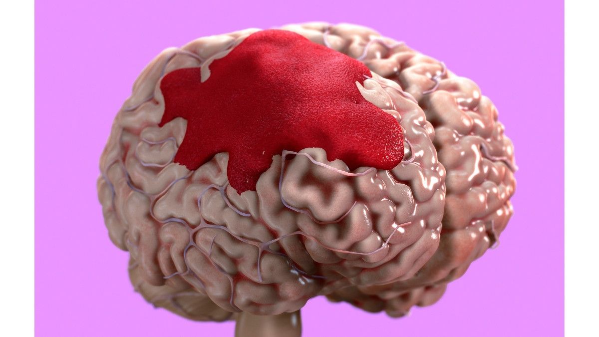 Penyebab Pendarahan Otak atau Hemoragik