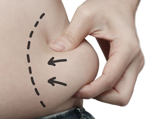 Risiko di Balik Sedot Lemak yang Perlu Anda Tahu