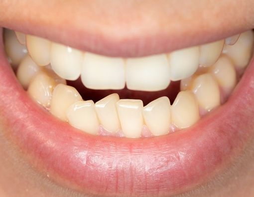 Kebiasaan Buruk Penyebab Gigi Berjejal