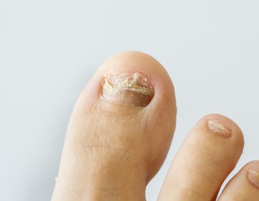 Atasi Jamur Kuku dengan 3 Cara Ini