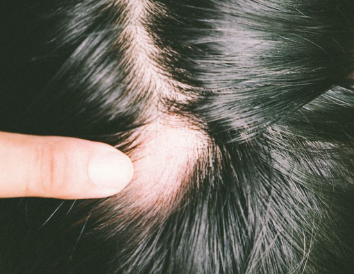 Bisakah Pitak Disembuhkan?