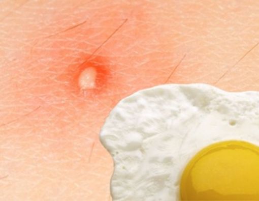 Makan Telur Sebabkan Bisulan Adalah Mitos