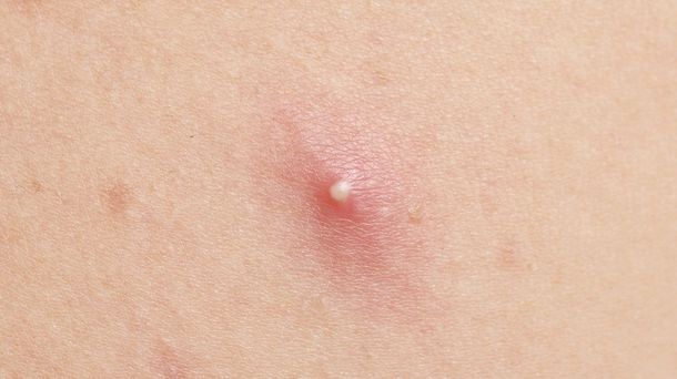 Ada Jerawat di Paha, Apa Penyebabnya? - KlikDokter