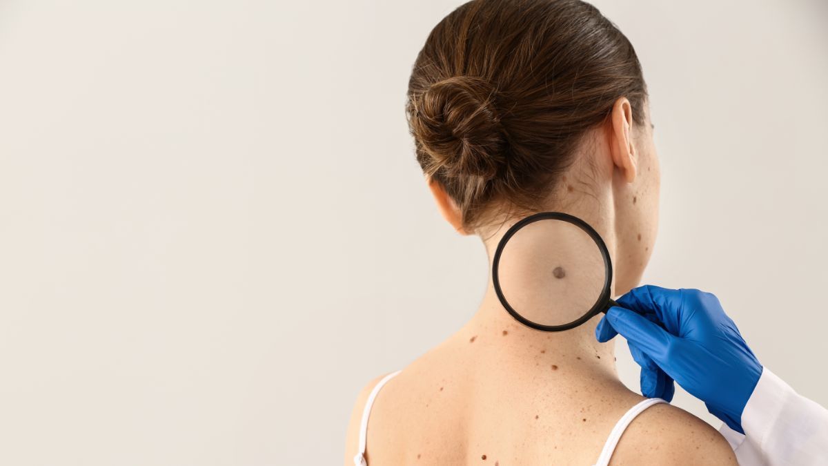 Macam-Macam Tanda Lahir dan Kenali Peringatan Bahayanya