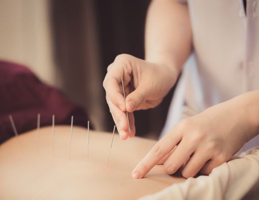 Efektifkah Akupunktur untuk Mengatasi Obesitas?